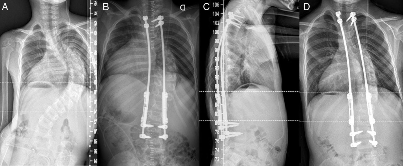 ایمپلنت تیتانیومی توسعه‌پذیر قفسه‌ی سینه یا VEPTR