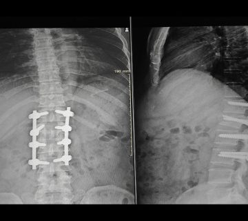 پیوند استخوان در جراحی انحراف ستون فقرات