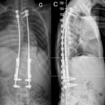 ایمپلنت تیتانیومی توسعه‌پذیر قفسه‌ی سینه یا VEPTR