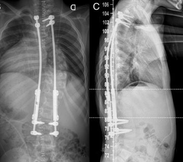 ایمپلنت تیتانیومی توسعه‌پذیر قفسه‌ی سینه یا VEPTR
