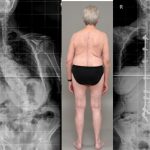 اسکولیوز دژنراتیو در بزرگسالان