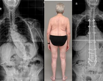 اسکولیوز دژنراتیو در بزرگسالان