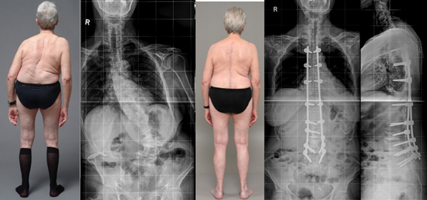 اسکولیوز دژنراتیو در بزرگسالان