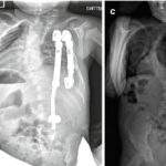 توراکوپلاستی در جراحی اسکولیوز