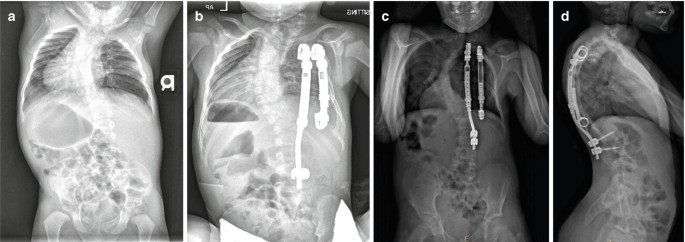 توراکوپلاستی در جراحی اسکولیوز