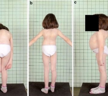 اسکولیوز مادرزادی