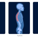ناهنجاری‌های ستون فقرات گردنی