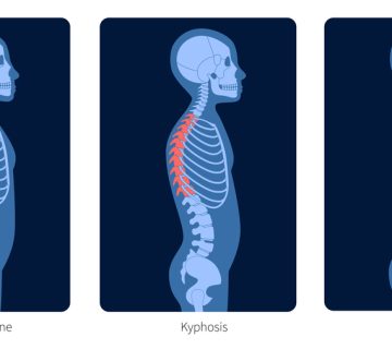 ناهنجاری‌های ستون فقرات گردنی